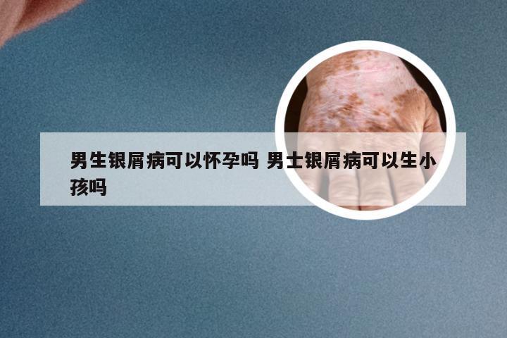 男生银屑病可以怀孕吗 男士银屑病可以生小孩吗