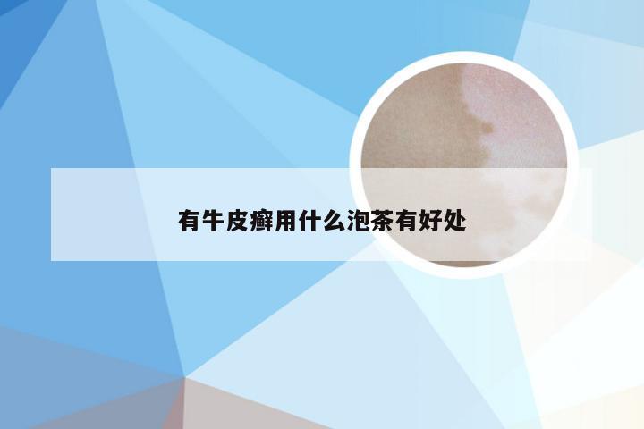 有牛皮癣用什么泡茶有好处
