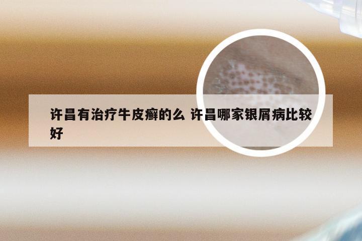 许昌有治疗牛皮癣的么 许昌哪家银屑病比较好