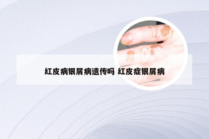 红皮病银屑病遗传吗 红皮症银屑病