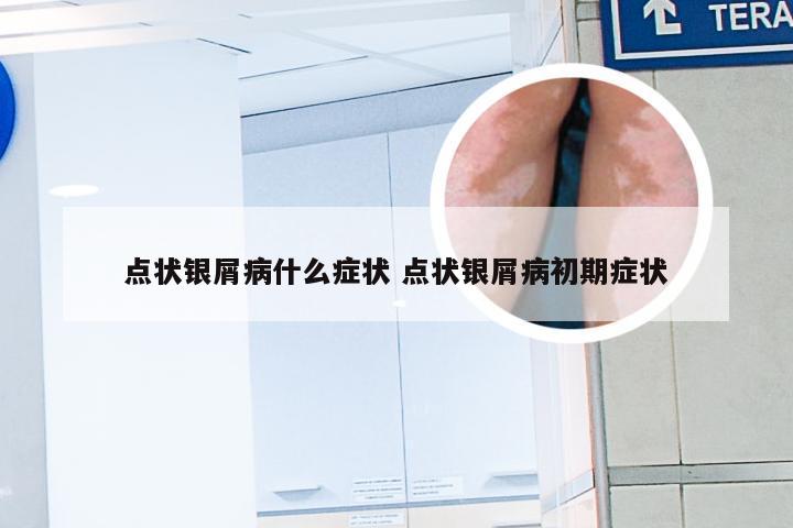 点状银屑病什么症状 点状银屑病初期症状