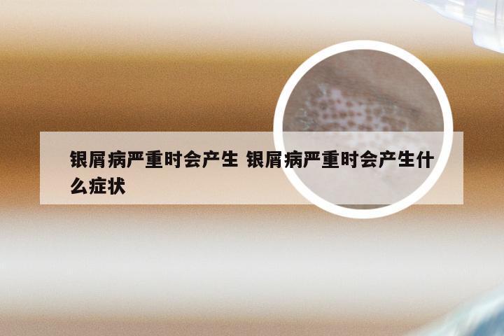 银屑病严重时会产生 银屑病严重时会产生什么症状