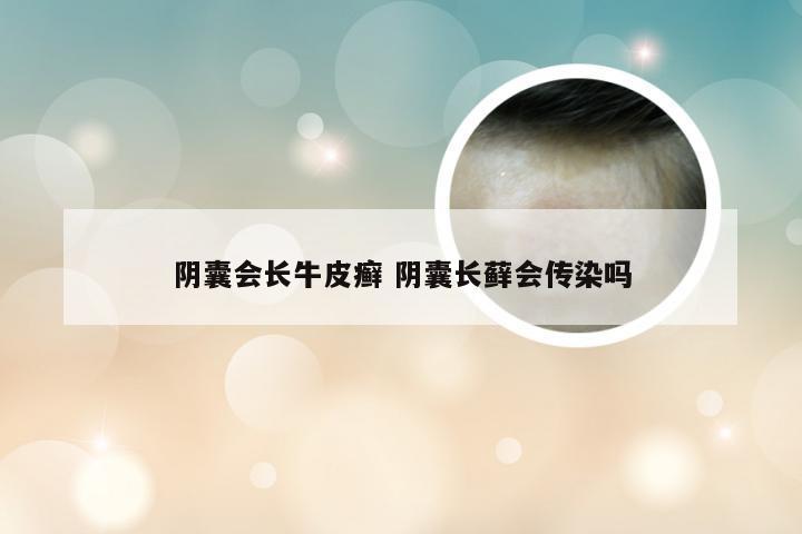 阴囊会长牛皮癣 阴囊长藓会传染吗