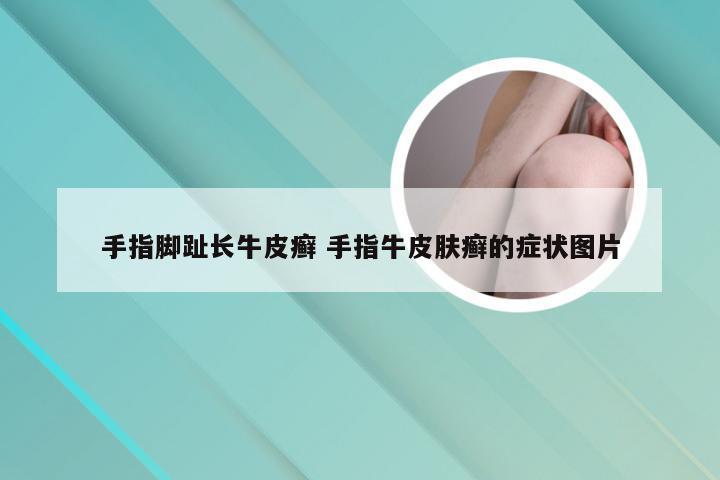 手指脚趾长牛皮癣 手指牛皮肤癣的症状图片