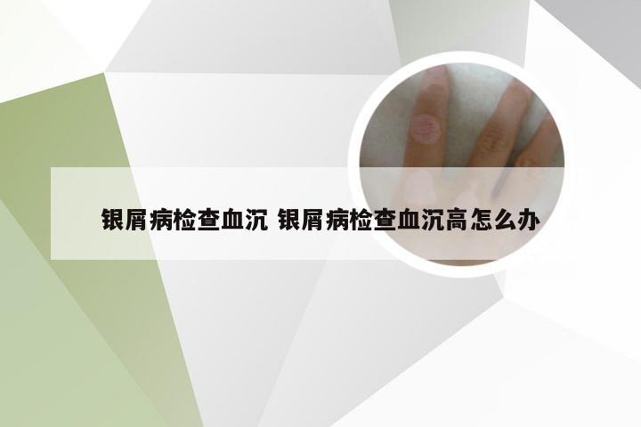 银屑病检查血沉 银屑病检查血沉高怎么办