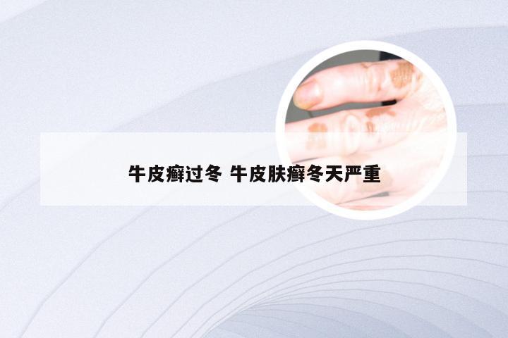 牛皮癣过冬 牛皮肤癣冬天严重