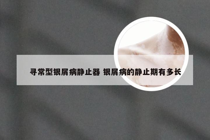 寻常型银屑病静止器 银屑病的静止期有多长