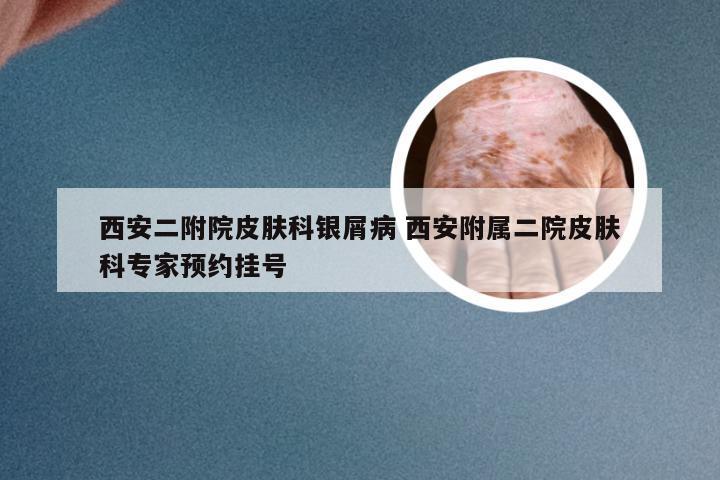 西安二附院皮肤科银屑病 西安附属二院皮肤科专家预约挂号