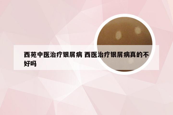 西苑中医治疗银屑病 西医治疗银屑病真的不好吗