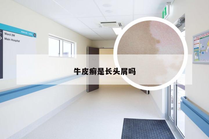 牛皮癣是长头屑吗