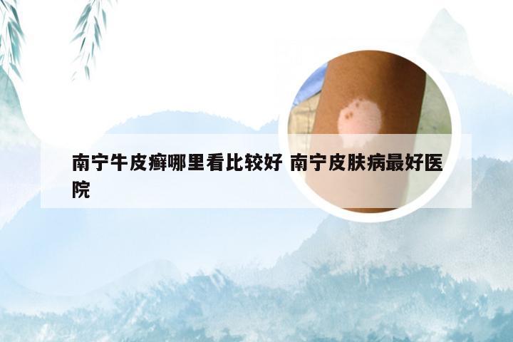 南宁牛皮癣哪里看比较好 南宁皮肤病最好医院