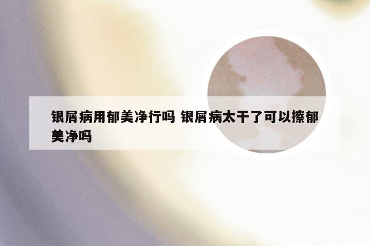银屑病用郁美净行吗 银屑病太干了可以擦郁美净吗