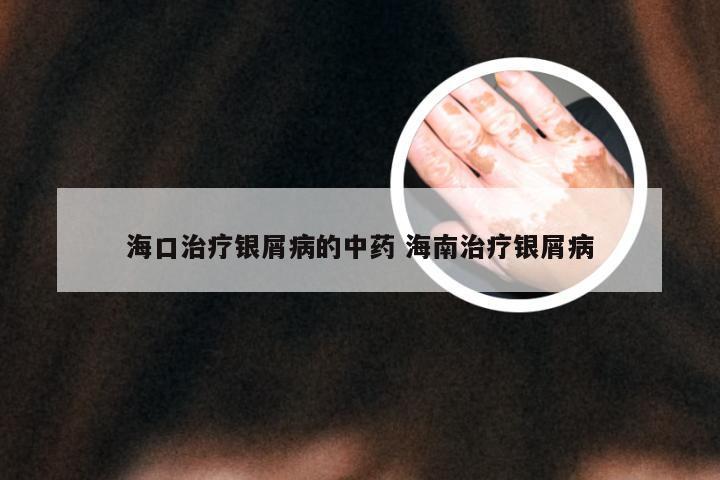 海口治疗银屑病的中药 海南治疗银屑病