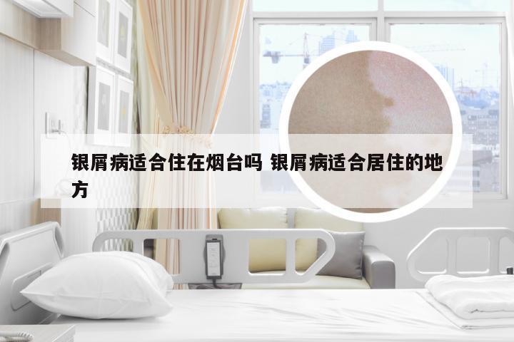 银屑病适合住在烟台吗 银屑病适合居住的地方