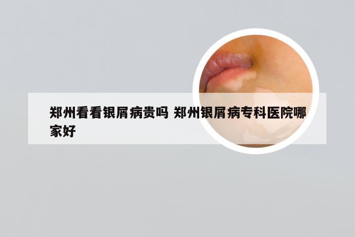 郑州看看银屑病贵吗 郑州银屑病专科医院哪家好