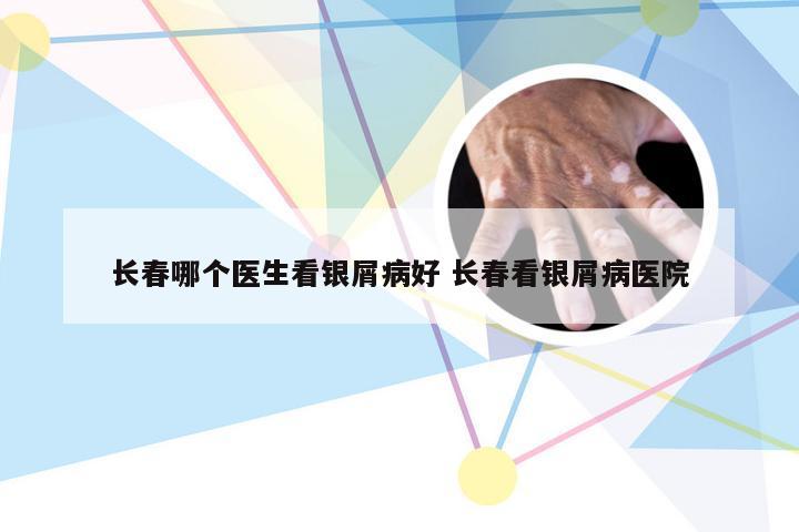 长春哪个医生看银屑病好 长春看银屑病医院