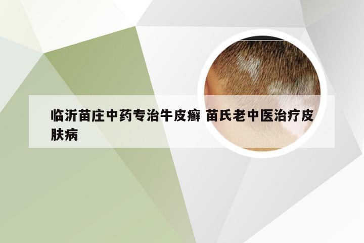 临沂苗庄中药专治牛皮癣 苗氏老中医治疗皮肤病