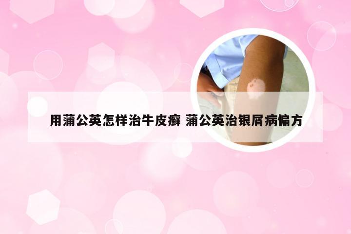 用蒲公英怎样治牛皮癣 蒲公英治银屑病偏方
