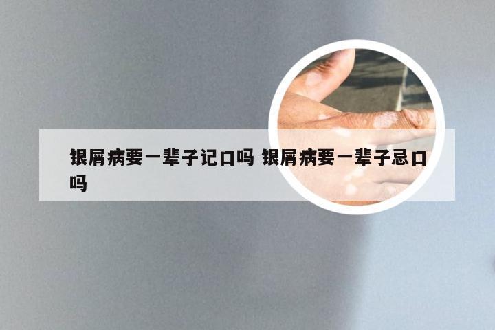 银屑病要一辈子记口吗 银屑病要一辈子忌口吗