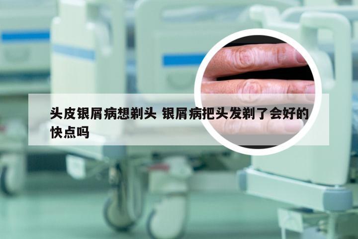 头皮银屑病想剃头 银屑病把头发剃了会好的快点吗