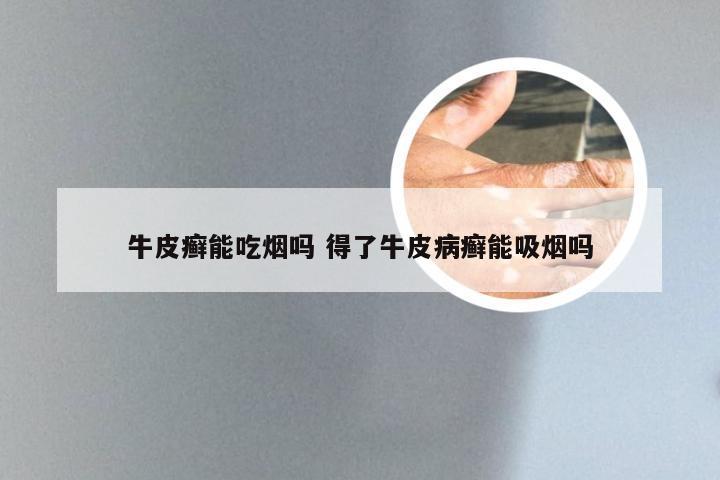 牛皮癣能吃烟吗 得了牛皮病癣能吸烟吗