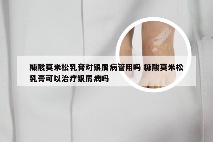 糠酸莫米松乳膏对银屑病管用吗 糠酸莫米松乳膏可以治疗银屑病吗