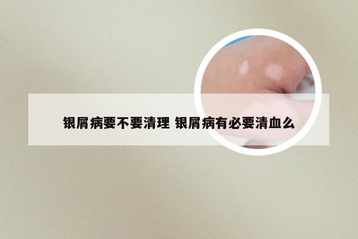 银屑病要不要清理 银屑病有必要清血么