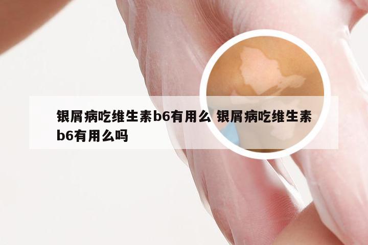 银屑病吃维生素b6有用么 银屑病吃维生素b6有用么吗