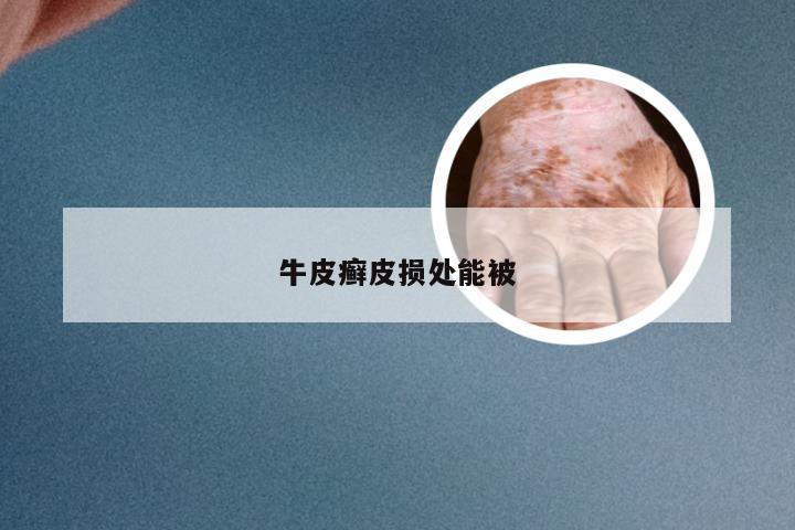 牛皮癣皮损处能被