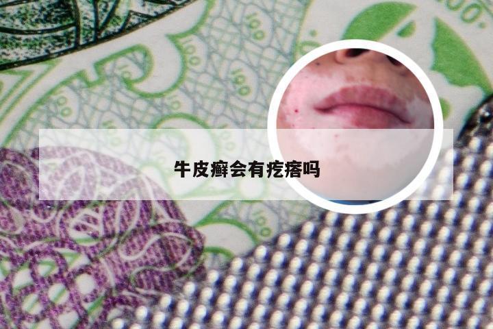 牛皮癣会有疙瘩吗