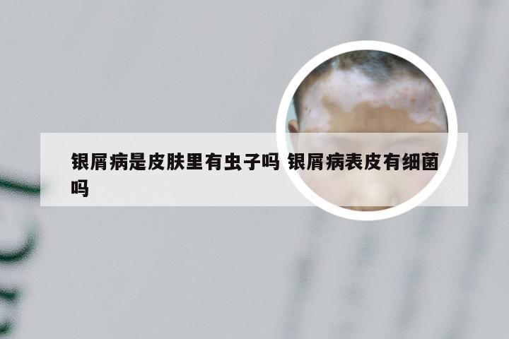 银屑病是皮肤里有虫子吗 银屑病表皮有细菌吗