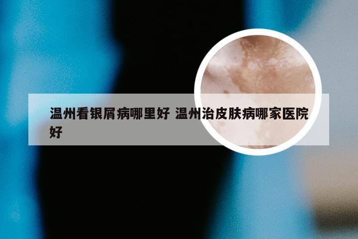 温州看银屑病哪里好 温州治皮肤病哪家医院好