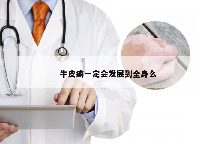 牛皮癣一定会发展到全身么