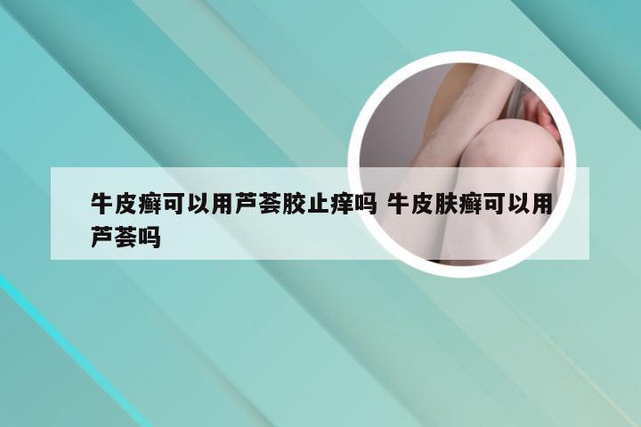 牛皮癣可以用芦荟胶止痒吗 牛皮肤癣可以用芦荟吗