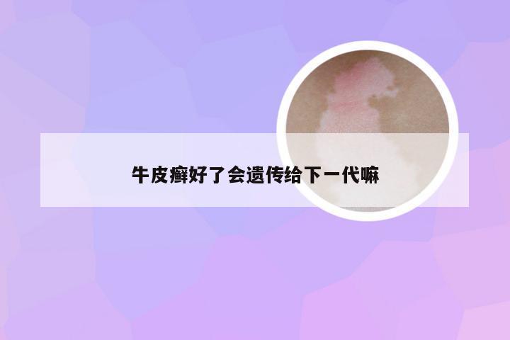 牛皮癣好了会遗传给下一代嘛