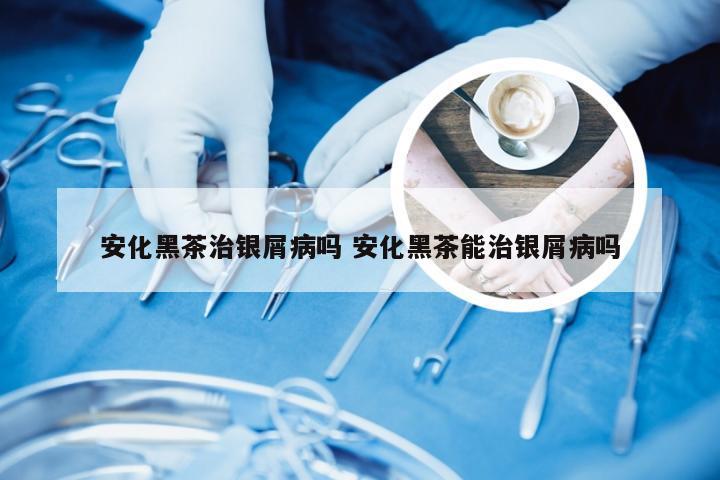 安化黑茶治银屑病吗 安化黑茶能治银屑病吗