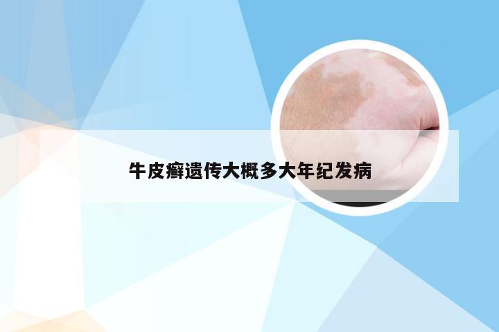 牛皮癣遗传大概多大年纪发病