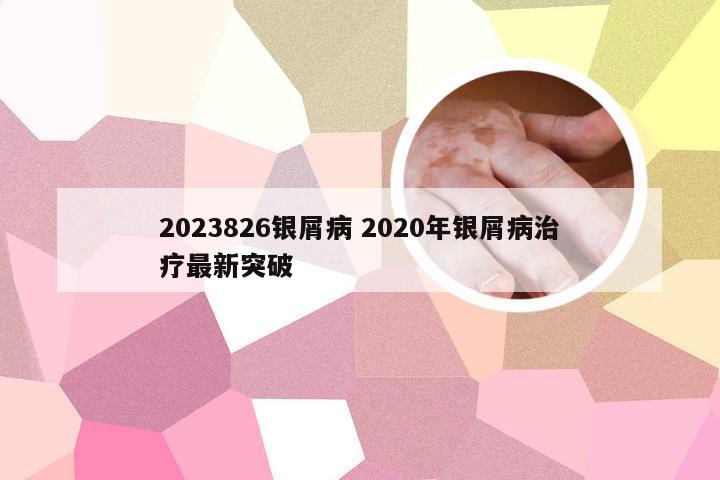 2023826银屑病 2020年银屑病治疗最新突破