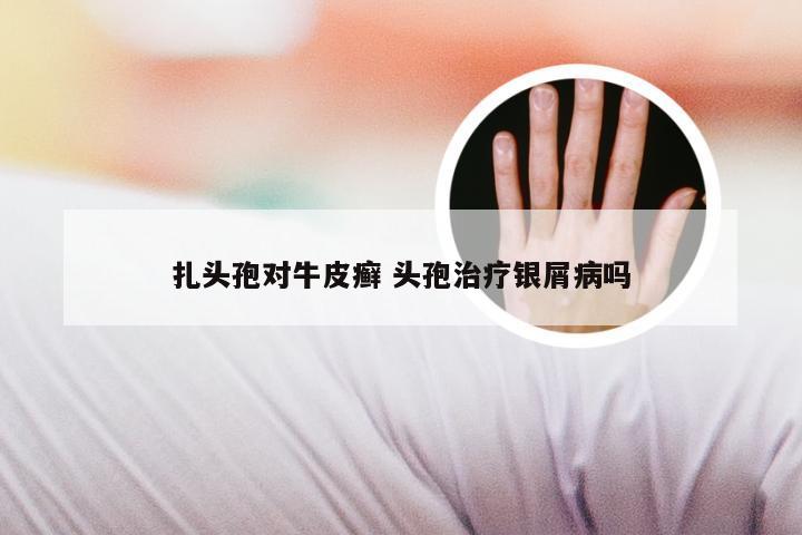 扎头孢对牛皮癣 头孢治疗银屑病吗