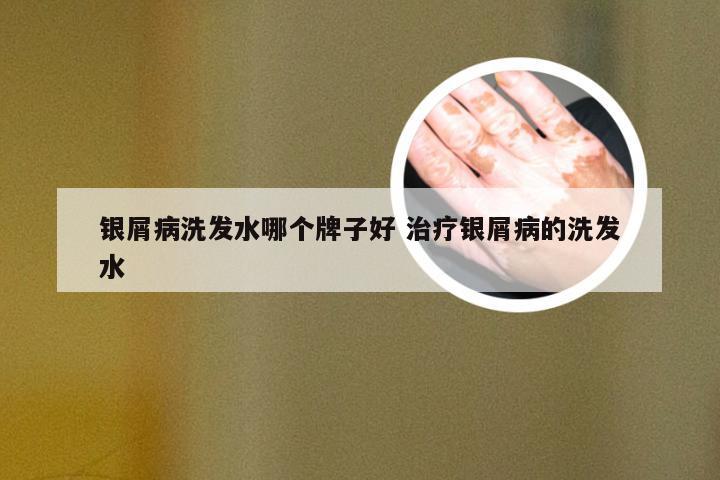 银屑病洗发水哪个牌子好 治疗银屑病的洗发水