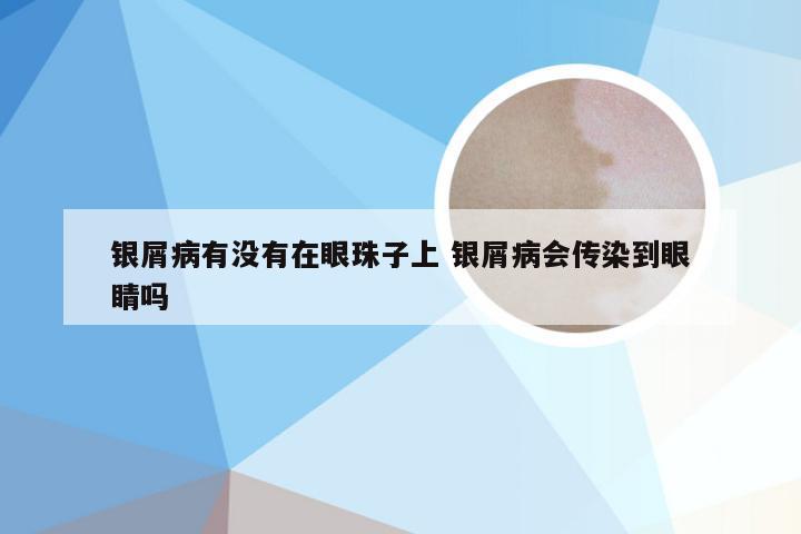 银屑病有没有在眼珠子上 银屑病会传染到眼睛吗