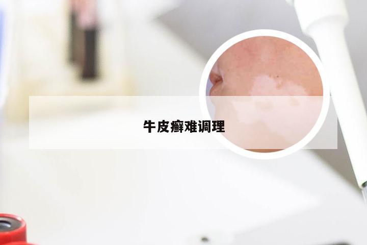牛皮癣难调理