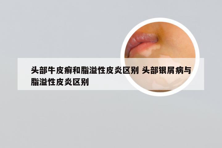 头部牛皮癣和脂溢性皮炎区别 头部银屑病与脂溢性皮炎区别