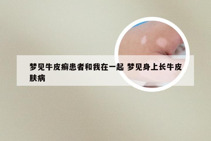 梦见牛皮癣患者和我在一起 梦见身上长牛皮肤病