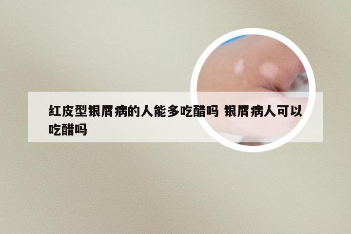 红皮型银屑病的人能多吃醋吗 银屑病人可以吃醋吗