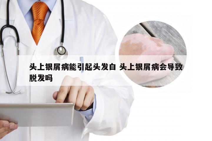 头上银屑病能引起头发白 头上银屑病会导致脱发吗