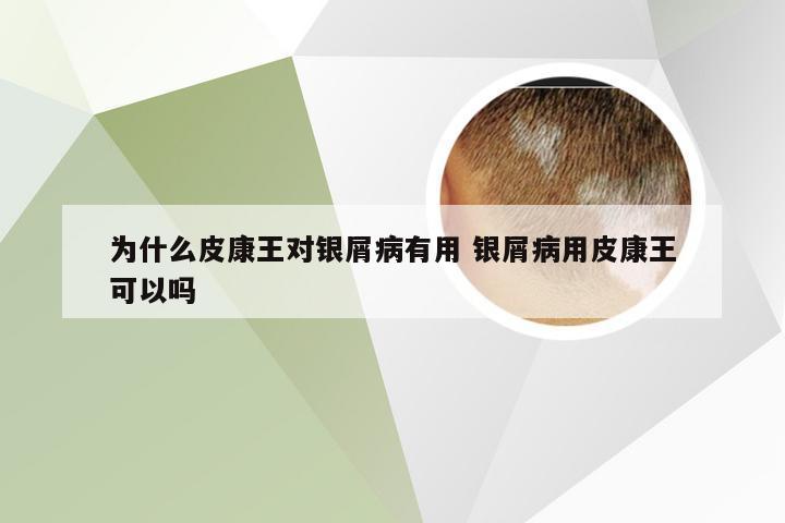 为什么皮康王对银屑病有用 银屑病用皮康王可以吗