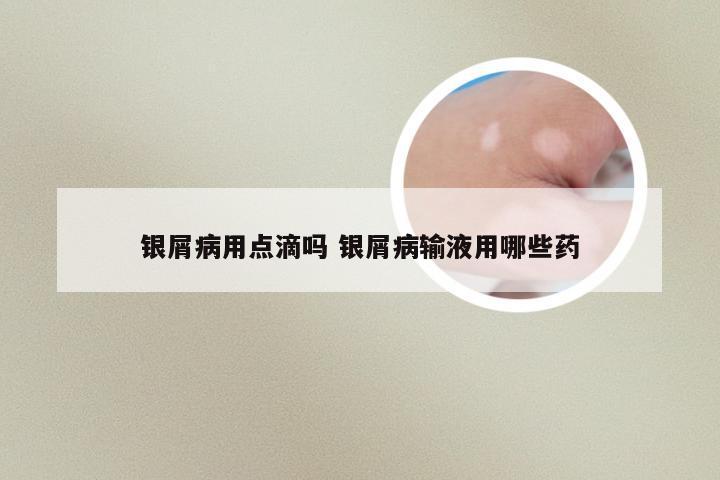 银屑病用点滴吗 银屑病输液用哪些药