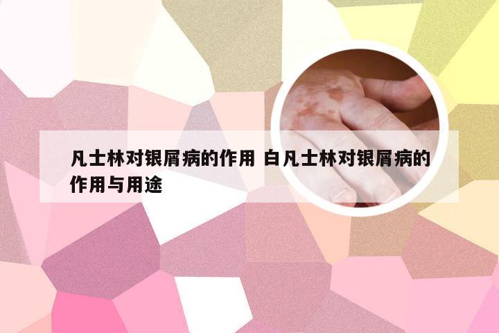 凡士林对银屑病的作用 白凡士林对银屑病的作用与用途