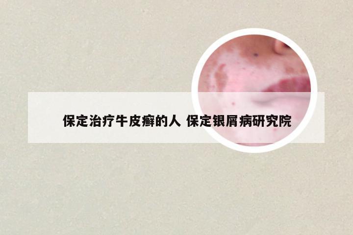 保定治疗牛皮癣的人 保定银屑病研究院